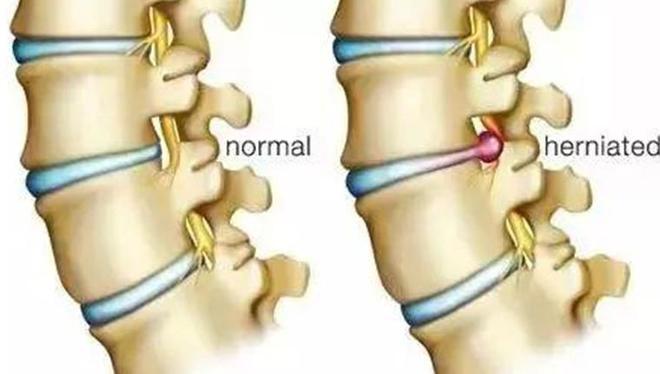 瑜伽教练因长期教习瑜伽导致腰椎间盘突出医生BOB半岛：严重点会瘫痪(图4)
