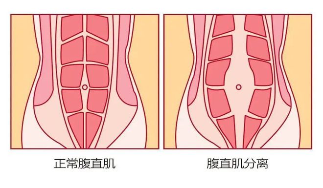 生娃后胯骨宽、肚子胖比减肥BOB半岛更有用的方法来了产后几年都有效(图9)